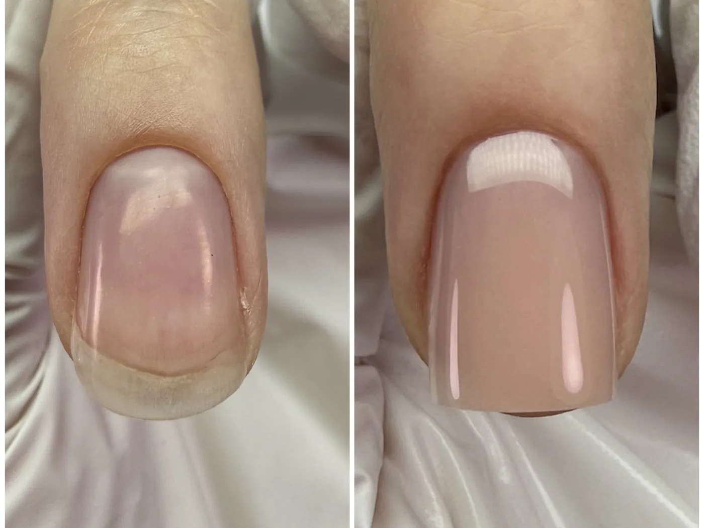 Trapezoid nail correction before and after example